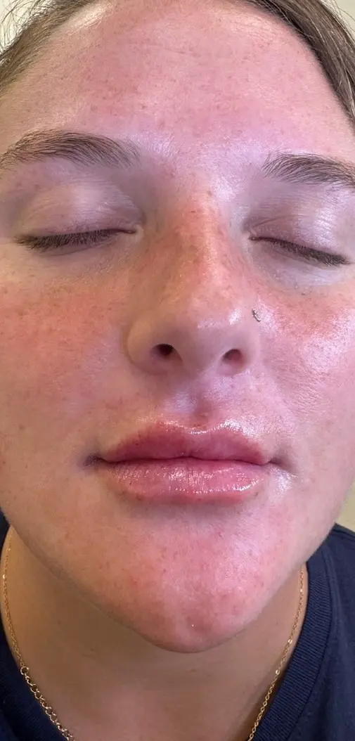 Smooth skin and natural lips with slight redness and a mole near the nose after Restylane at Refresh MedSpa.