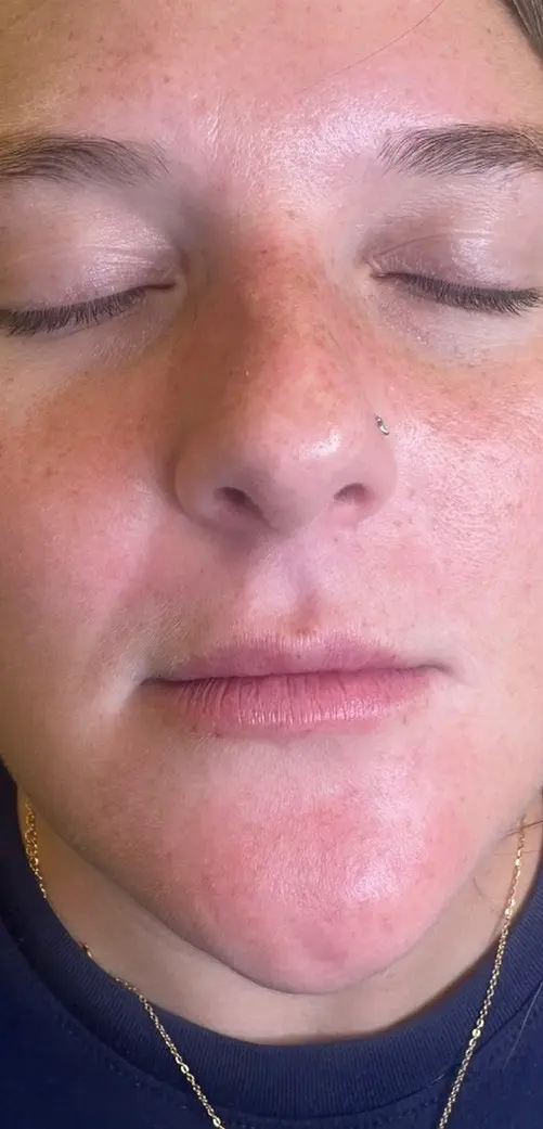 Person's face close-up with eyes closed, small nose piercing, and flushed skin before Restylane at Refresh MedSpa.