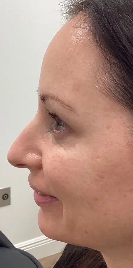 Woman with fair skin and dark hair in profile after wrinkle relaxers at Refresh MedSpa, plain background.