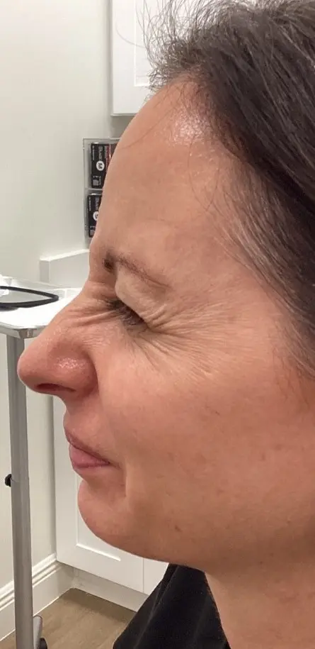 Before wrinkle relaxers at Refresh MedSpa, woman scrunches face, deep wrinkles visible near nose and eyes.