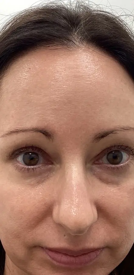 Woman's face close-up, neutral expression, minimal makeup after Xeomin at Refresh MedSpa. Forehead to mouth visible.