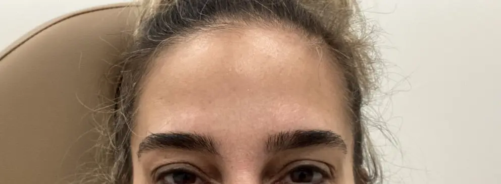 Close-up of a person’s forehead and eyes after Dysport at Refresh MedSpa, against a beige headrest and white background.