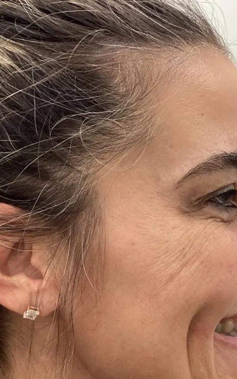 Smiling woman’s profile with smooth, line-softened skin after Botox at Refresh MedSpa.