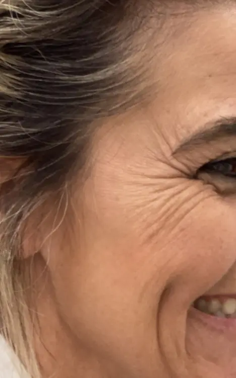 A woman smiles, showing eye wrinkles and smile lines before Botox at Refresh MedSpa.