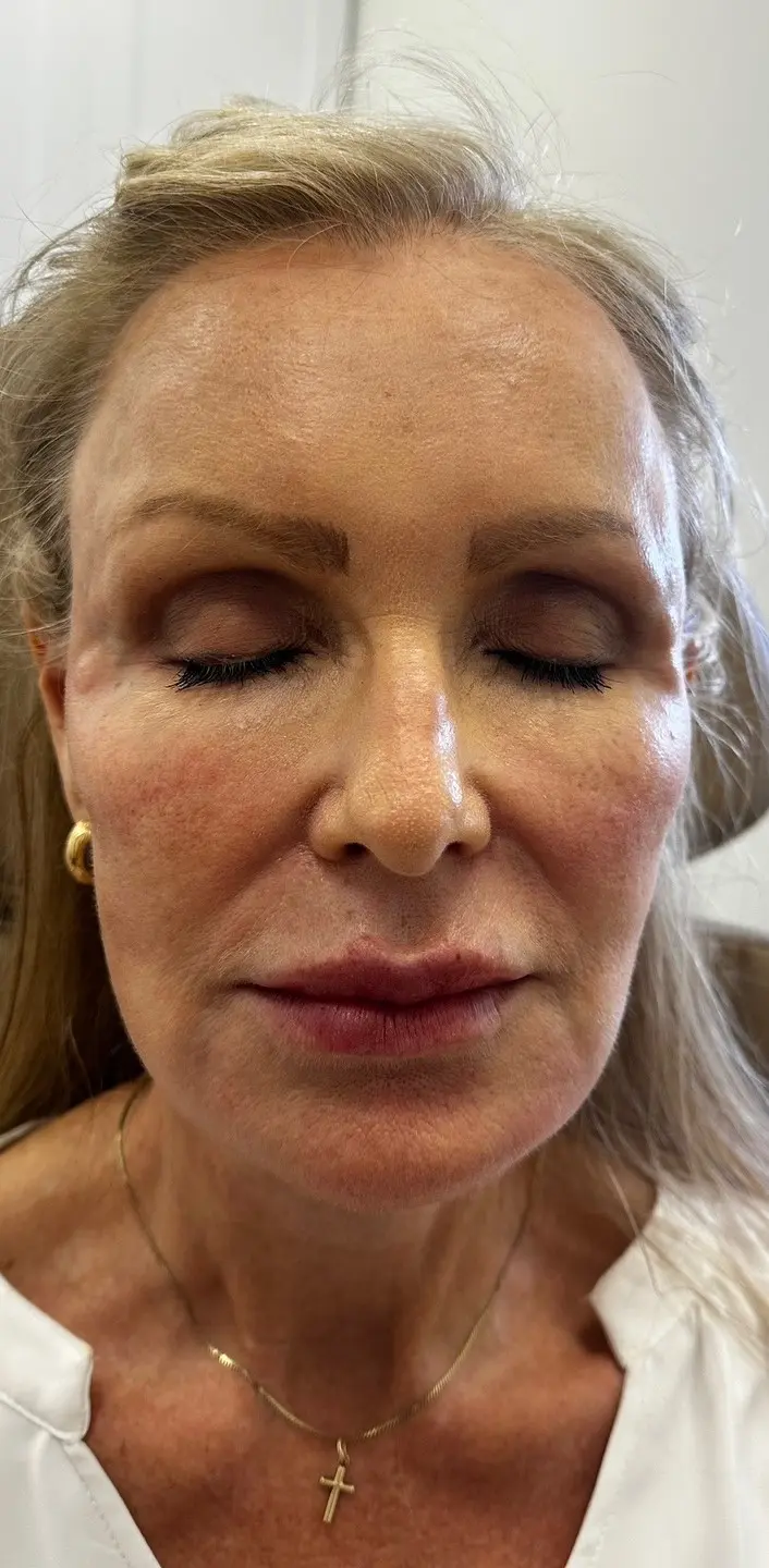 Close-up of a blonde, middle-aged woman post-Juvederm at Refresh MedSpa, eyes closed, white top, gold jewelry.