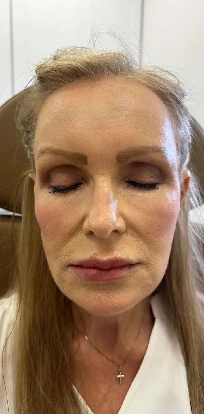 A middle-aged woman with long blonde hair, full makeup, and a cross necklace before Juvederm at Refresh MedSpa.