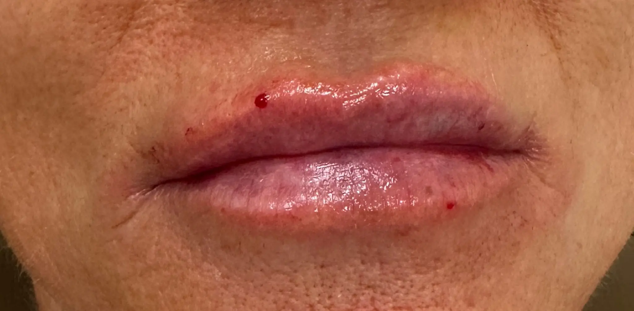 Person’s lips with minor blood spots and swelling after dermal fillers at Refresh MedSpa.