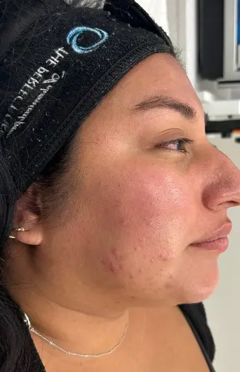 After a HydraFacial at Refresh MedSpa, a woman with clear skin and mild acne scars wears a black headband.