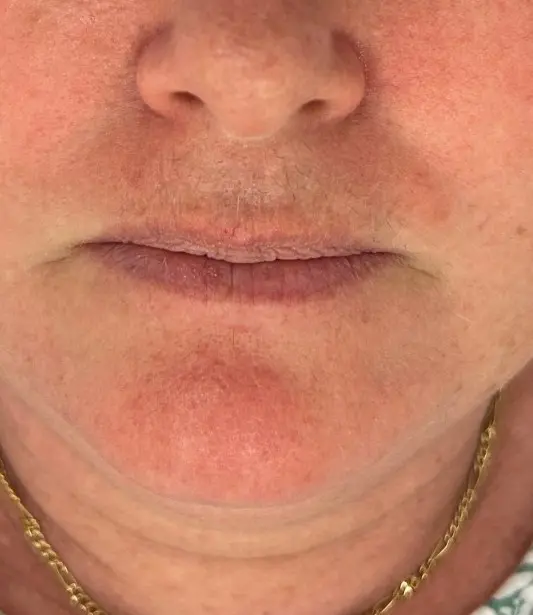 Lower half of face and neck with chapped lips, light stubble, gold chain—potential BBL laser treatment at Refresh MedSpa.