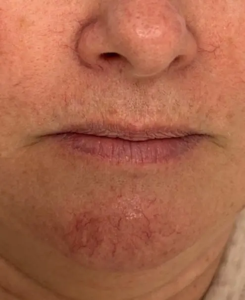 Visible red spider veins on chin in close-up of lower face before BBL Photofacial at Refresh MedSpa.