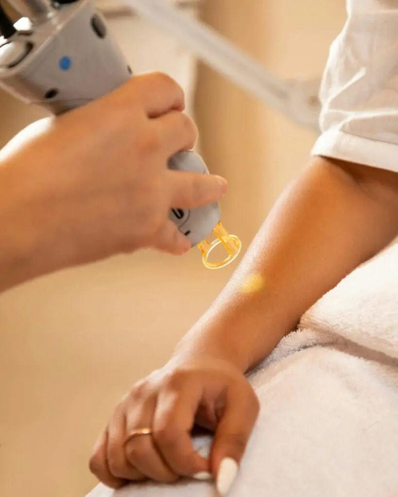 A person receives a laser treatment on their forearm while lying on a towel-covered surface.