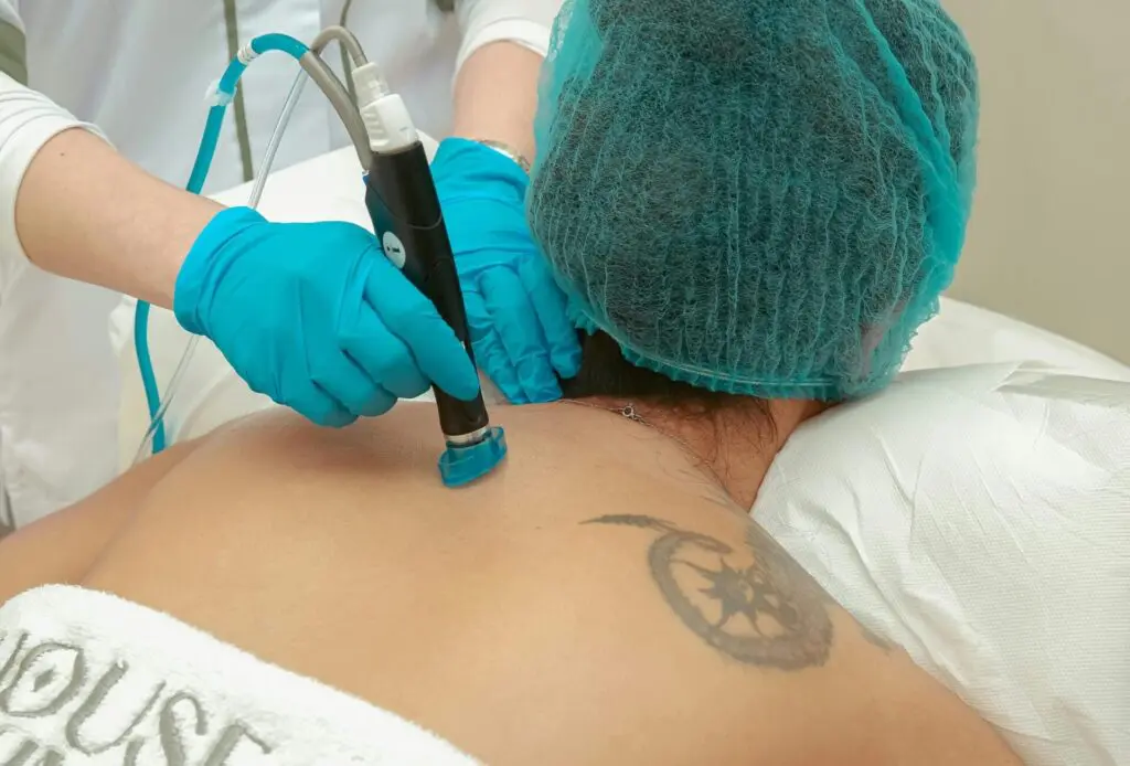 A person receiving a back treatment with a medical device; the individual has a tattoo and is lying face down, while wondering about Does Laser Hair Removal Affect Tattoos in Cape Coral and Fort Myers, FL